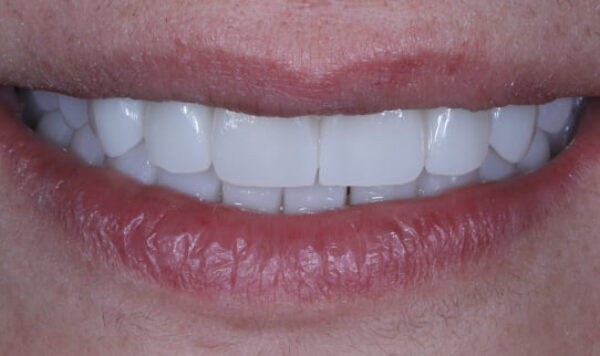 After - Lusk Orthodontics