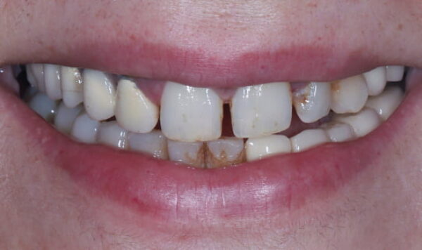 Before - Lusk Orthodontics
