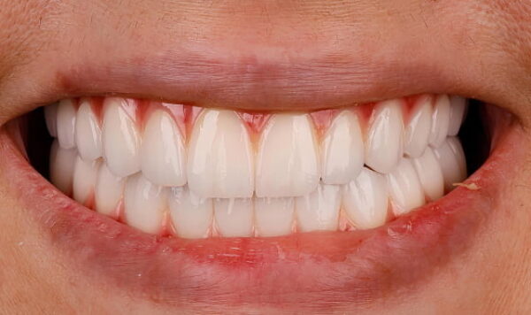 After - Lusk Orthodontics