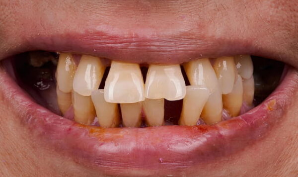 Before - Lusk Orthodontics