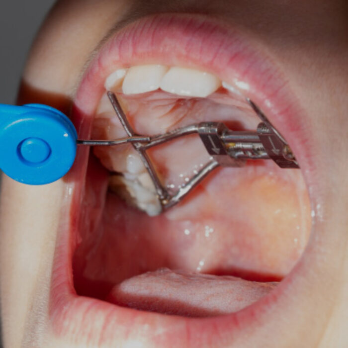 Treatments - Lusk Orthodontics