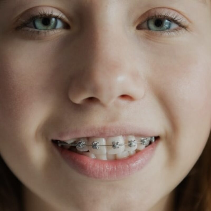 Treatments - Lusk Orthodontics