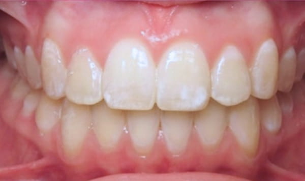 After - Lusk Orthodontics
