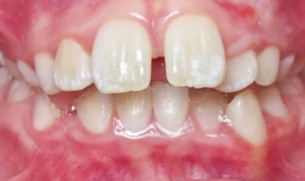 Before - Lusk Orthodontics