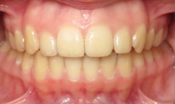 After - Lusk Orthodontics
