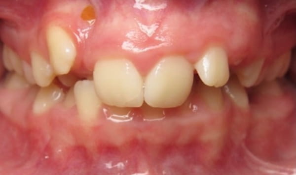 Before - Lusk Orthodontics