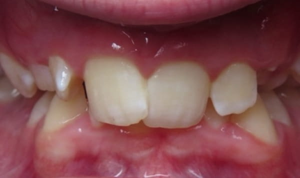 Before - Lusk Orthodontics
